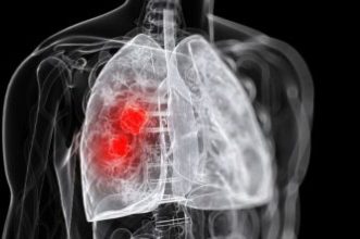 lung-cancer-oncologynewscomau_900x940-e1500776916478-351×221