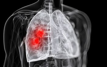 lung-cancer-oncologynewscomau_900x940-e1500776916478-351x221